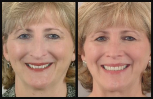 Reverse The Aging Process With A New Smile By Robert Stoner Orthodontics