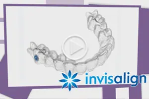 Invisalign Video Thumbnail